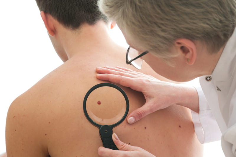 Dermatologist examining mole on patient