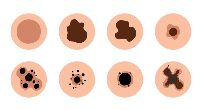 Different types of mole